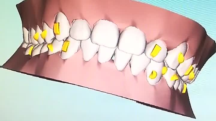 Выравнивание зубного ряда посредством брекетов! 