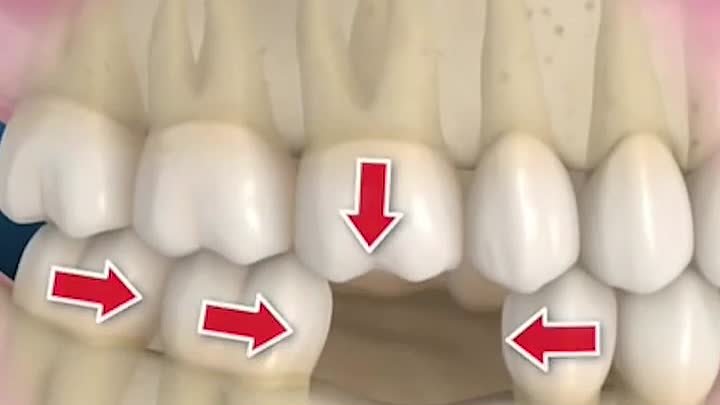 Отсутствие зуба вредит всему зубному ряду! 