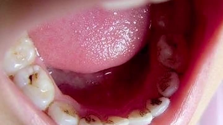 Как лечат кариес и ставят пломбы у нас в стоматологии! 