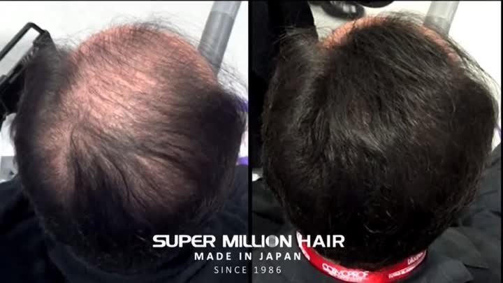 Super Million Hair - лучшее средство для редких волос!