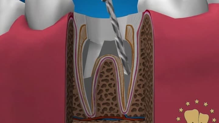 Ортопедическая стоматология - Культевые вкладки