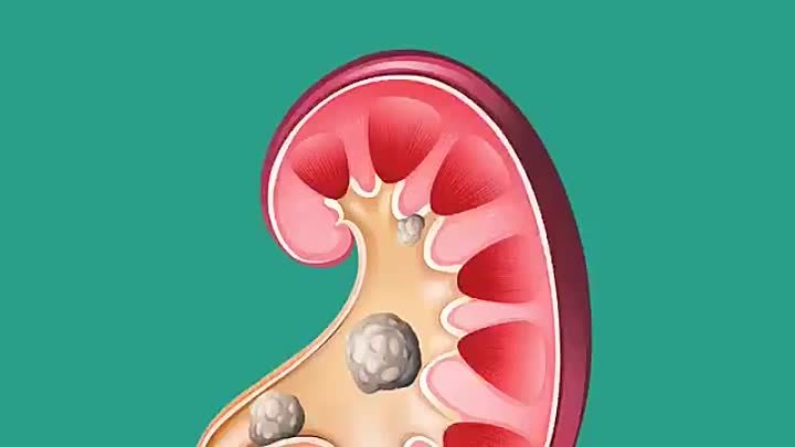 Камни в почках