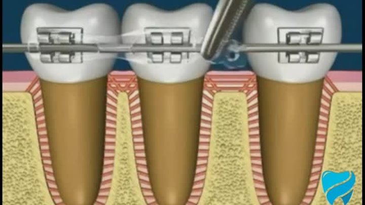 Смещение зубов и перестройка кости во время лечения брекетами