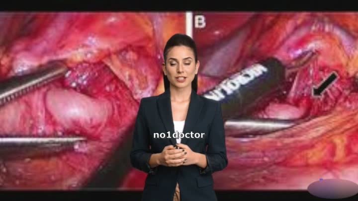 Median arcuate ligament syndrome