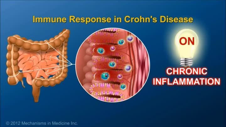 Видео Болезнь Крона.