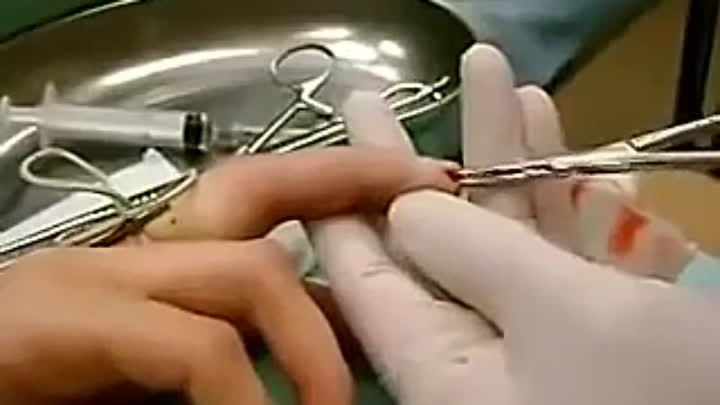 Хирургическая операция - удаление пиогенной гранулемы