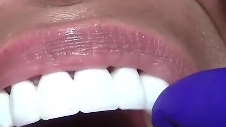Установка зубного моста в стоматологии в Хэйхэ!