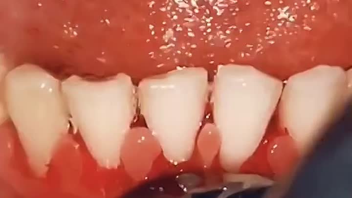 Как зубной камень влияет на десна и зубы?