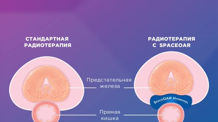 Лечение рака простаты в Израиле