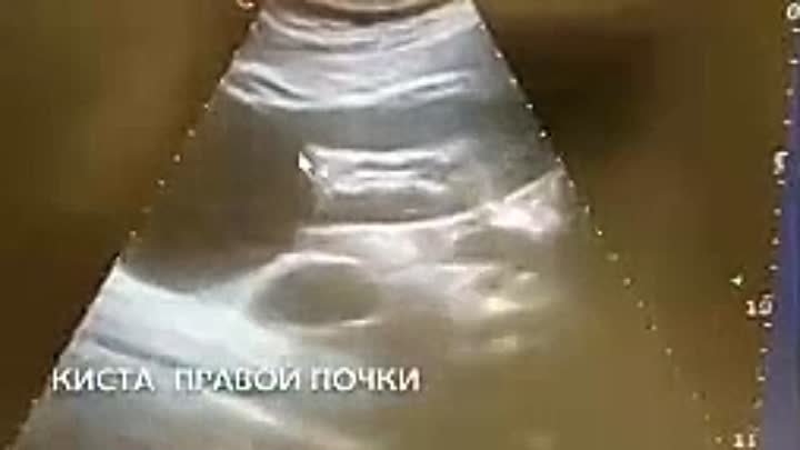 киста почки видео