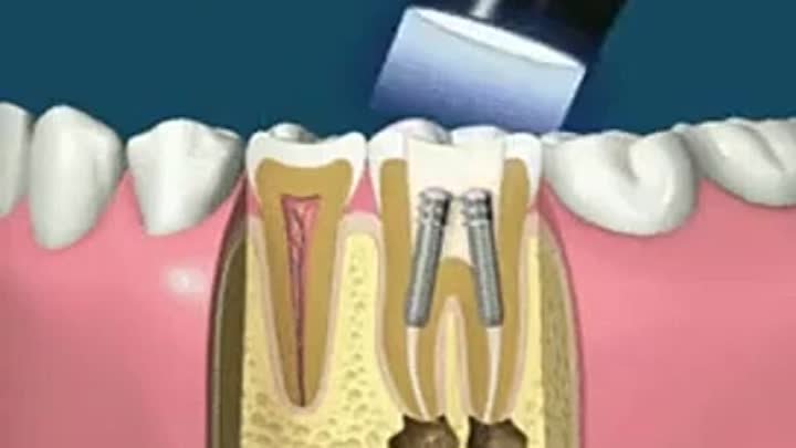 Пломбирование канала и установка коронки