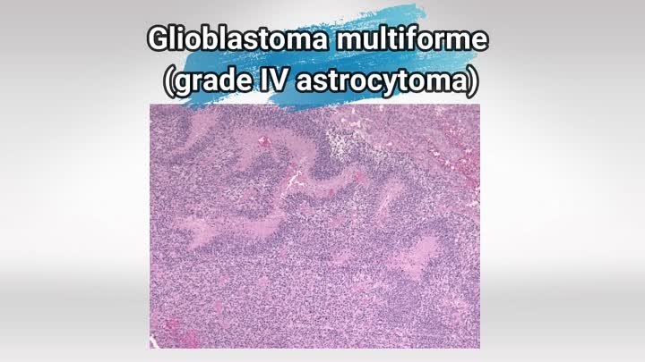 Usmle Videos - (dratef.net) Glioblastoma, Astrocytoma, and Meningioma ( medical.shoppingdealer.com )