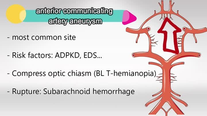 Usmle Videos - (dratef.net) Brain Stroke And Aneurysm ( medical.shoppingdealer.com )