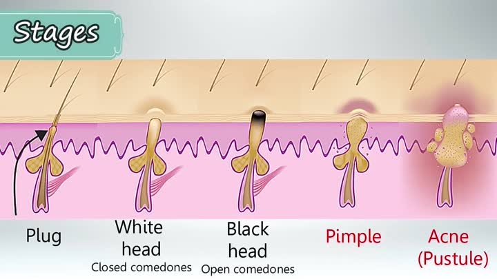 Usmle Videos - (dratef.net) Acne Vulgaris Treatment Benzoyl Peroxide, Topical Retinoid, Retinoic Acid ( medical.shoppingdealer.com )