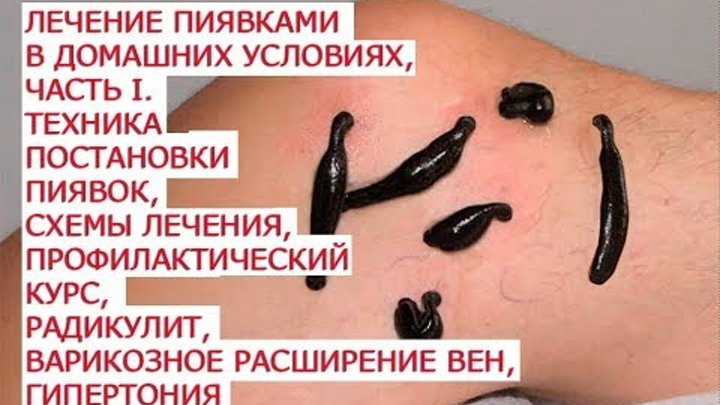 Как выглядит укус пиявки на коже Как выглядит укус пиявки на коже