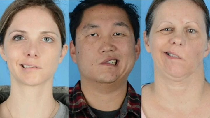 Инсульт фото до и после Инсульт фото до и после