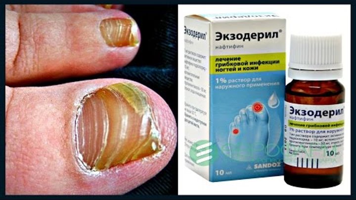 Фото лечение грибка ногтей отзывы Фото лечение грибка ногтей отзывы