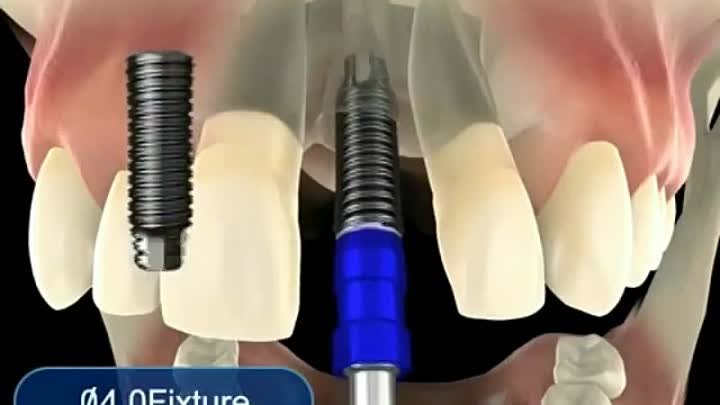 Удаление зуба с одномоментной установкой имплантата