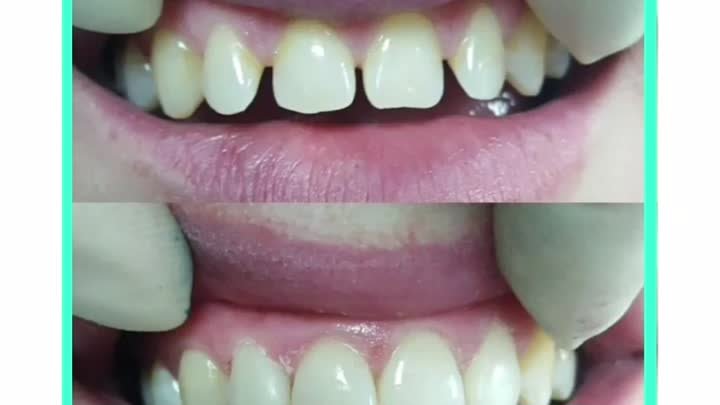 Вариант РЕСТАВРАЦИИ зубов в стоматологии ВЕДИ Оренбург 