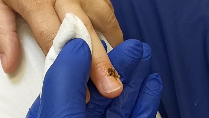 Удаление фибромы на пальце руки в МЦ"КлиникДерм"