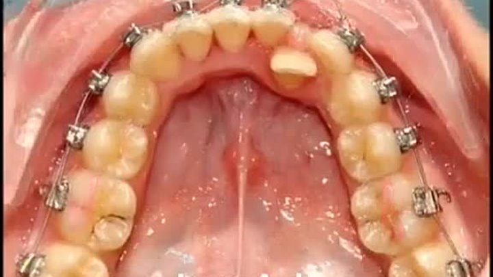 Возможности ортодонтического лечения с помощью брекет-системы