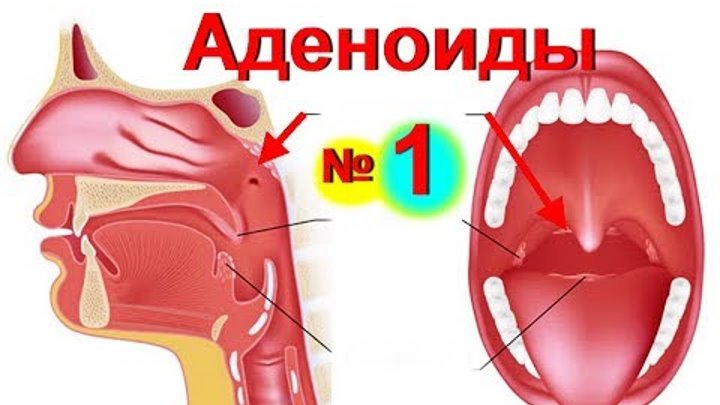 Как выглядит горло после удаления аденоидов Как выглядит горло после удаления аденоидов