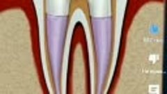 Как лечат зуб, удаление нерва 