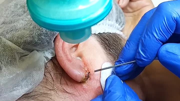 Лазерное удаление келлоидного рубца на мочке уха в МЦ КлиникДерм  (1 ...