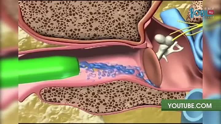 Вода в ухе фото Вода в ухе фото