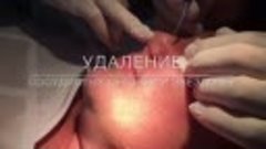 Удаление сосудистых сеточек и звёздочек. Запись по тел. ☎3-9...