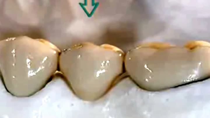 24. Несъемное протезирование зубов
