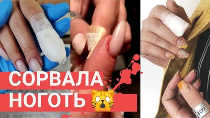 Как снять ноготь с пальца Как снять ноготь с пальца