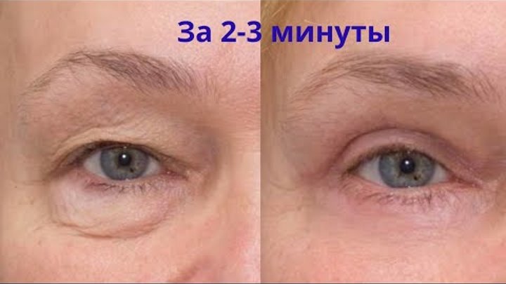 Как снять отек с века верхнего быстро Как снять отек с века верхнего быстро