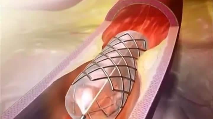 Коронарное стентирование. Стентирование сосудов сердца. Коронарное стентирование сосудов сердца. Стент видео