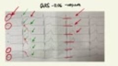 Научись анализировать ЭКГ за 7 минут!!! (Подробный разбор ЭК...