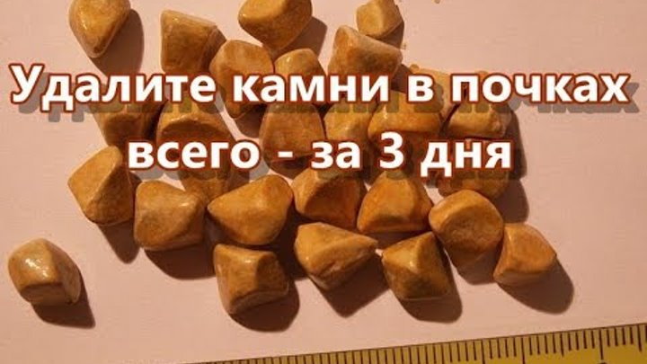 Как правильно снимает камни Как правильно снимает камни