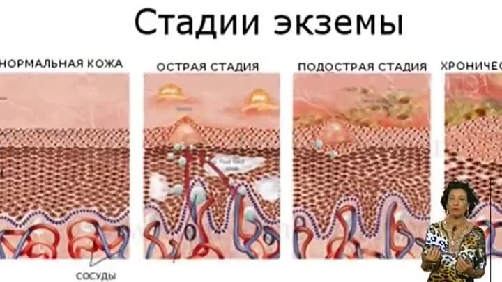 Как выглядит экзема на руках Как выглядит экзема на руках