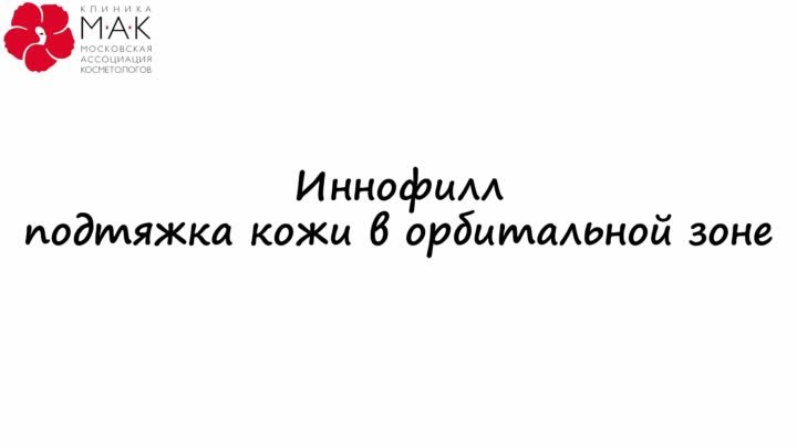 Иннофилл. Подтяжка кожи в орбитальной зоне.