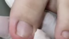 Врастание ногтевой пластины