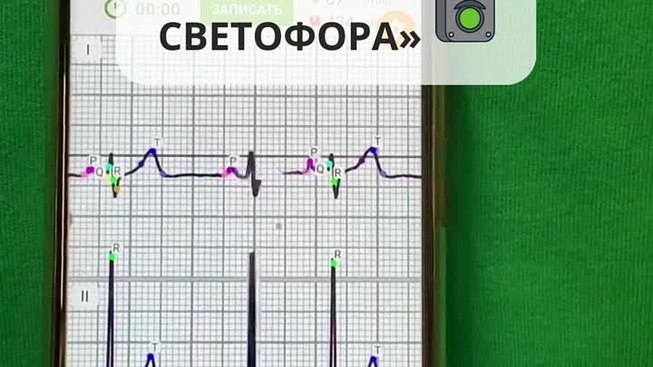 Как установить электроды у кардиофлешки ECG Dongle