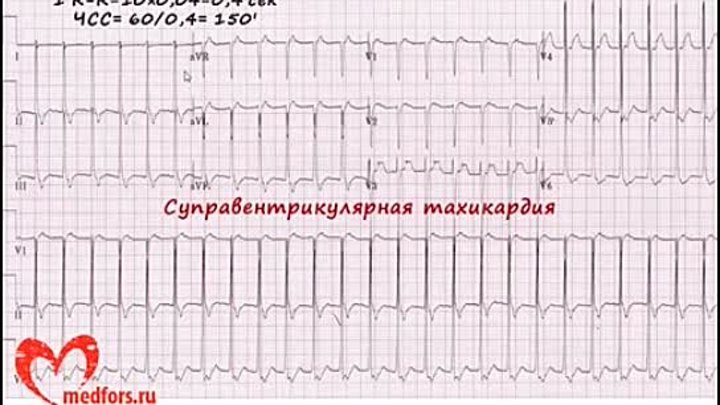 Урок 5. Видеокурс 'ЭКГ под силу каждому'.