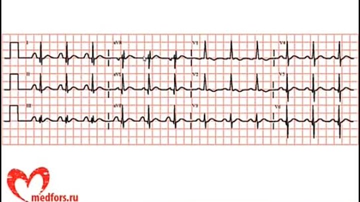 Урок 8. Видеокурс 'ЭКГ под силу каждому'.