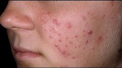 Угревая сыпь на лице  | Лечение угревой сыпи в домашних усло...