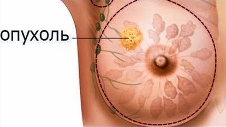 Рак груди симптомы на ранней стадии фото Рак груди симптомы на ранней стадии фото