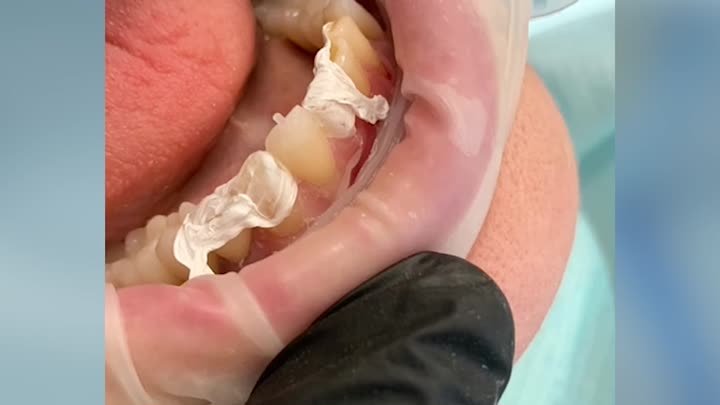Композитные виниры техника инъекционного прессования без обточки зубов