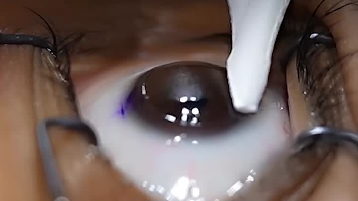 лечение глаза лазером - Lasik-10