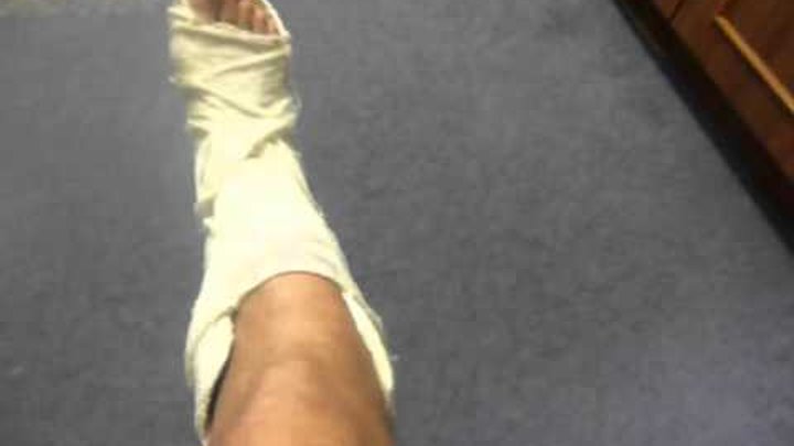 Как выглядит перелом ноги фото Как выглядит перелом ноги фото