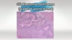 Usmle Videos - (dratef.net) Glioblastoma, Astrocytoma, and M...