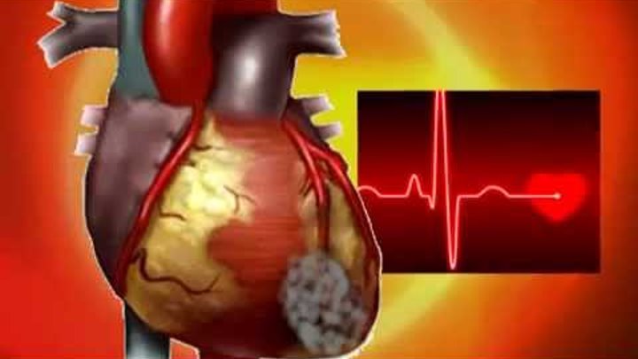 Инфаркт миокарда фото сердца настоящего Инфаркт миокарда фото сердца настоящего